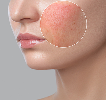 Контактный дерматит: как убрать покраснение кожи лица